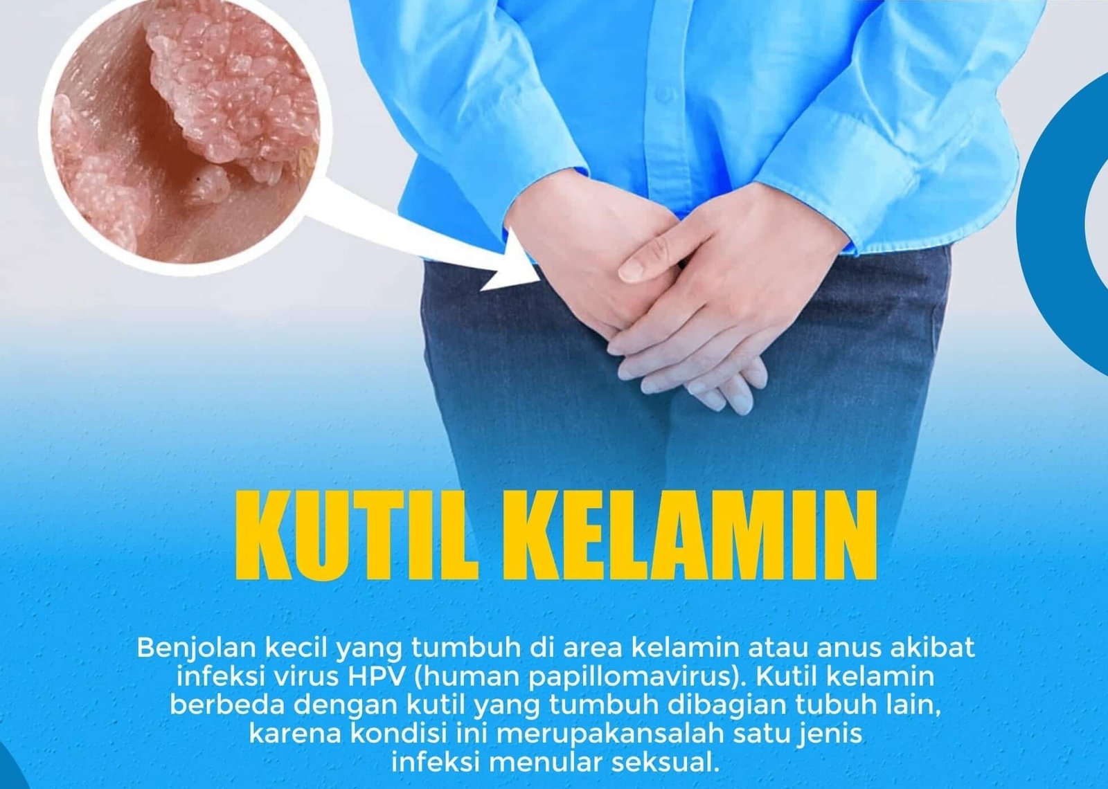 Kutil Kelamin Klinik Newton