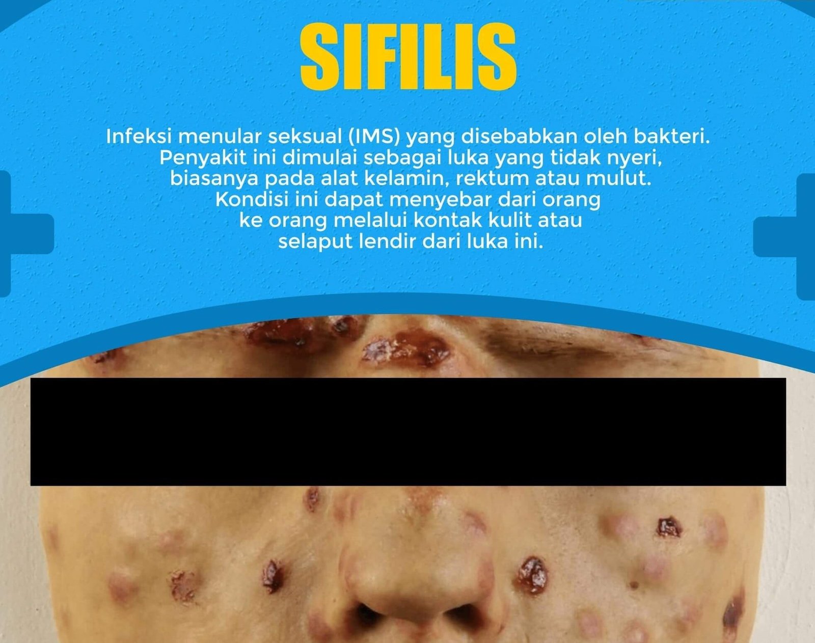 Sifilis Klinik Newton